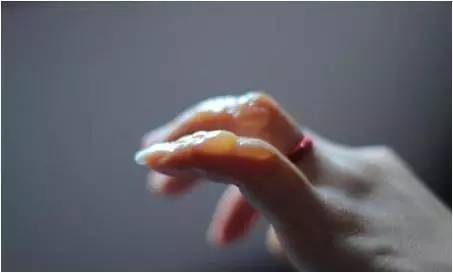 冬天生冻疮怎么办简单方法,冬天长冻疮是因为太冷了吗