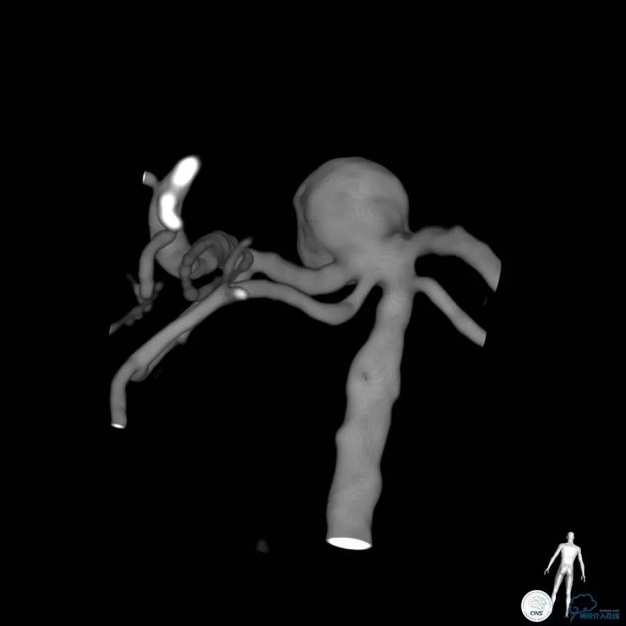 颈动脉瘤介入栓塞康复后可活多久,动脉瘤微创栓塞术全过程