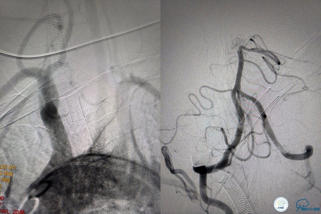 一例急性基底动脉尖综合征患者的支架取栓治疗