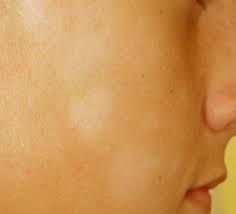 被医院皮肤科误诊了怎么办,皮肤科常见病褐色斑