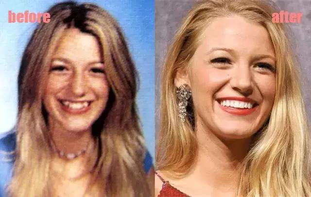 整牙=整容?看杨幂、刘涛、高圆圆为你亲身示范!