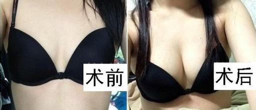 鼻子整形保质期多久,整形维护期大概是多久