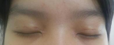 双眼皮“留疤”要多难看多难看,如何防止,留疤如何挽回?