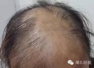 全身发痒是新冠吗怎么治疗,得新冠全身痒