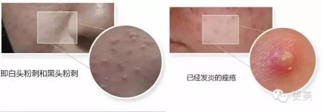 长痘痘好焦虑啊,长痘痘要用什么药治疗
