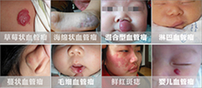血管瘤不复发的治疗,鼻血管瘤手术后复发