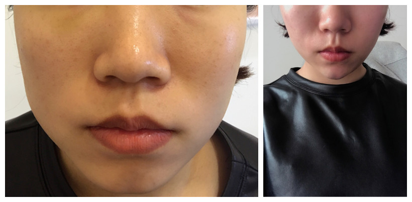 玻尿酸做微整形,玻尿酸微整和线雕提拉