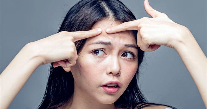 为什么脸上的痘痘不能随便挤,脸上有痘痘该挤还是不挤