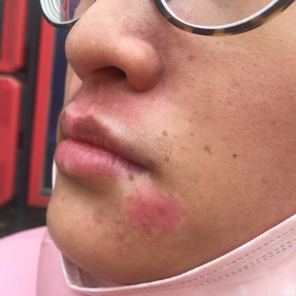 白斑光照,白斑光照后图片