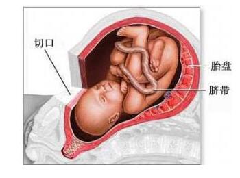 剖腹产伤口贴纸撕掉后怎么护理,剖腹产术后护理注意事项