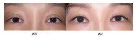 想要双眼皮就双眼皮吗,眼睛小割双眼皮是不是会好看很多