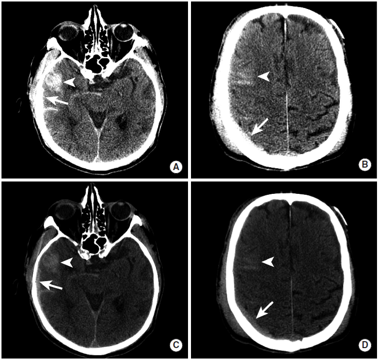 多图颅内出血影像学表现大全,头被撞后颅内出血有什么表现