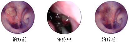 pdt光动力治疗肿瘤,肿瘤的mdt在肿瘤综合治疗中的地位