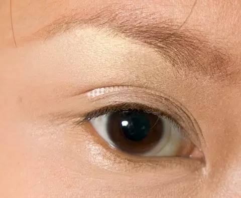 不开刀单眼皮怎么变双眼皮,内双不动刀怎么能变双眼皮