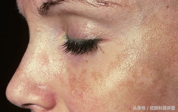 突然长了褐色的斑是怎么回事,突然长斑了怎么办