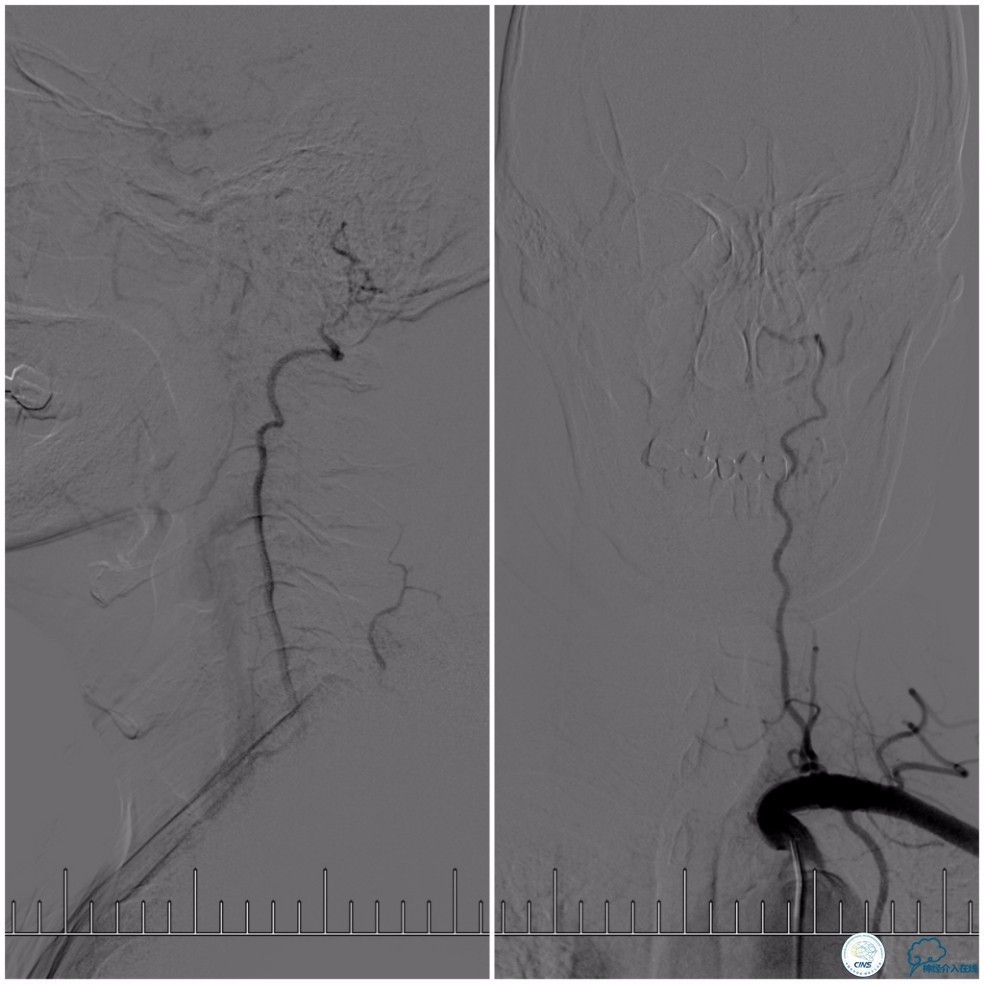 天坛周记|基底动脉狭窄合并动脉瘤血管内介入治疗一例