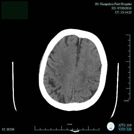 CINS2016病例展｜一例双侧大脑前动脉栓塞的再通治疗