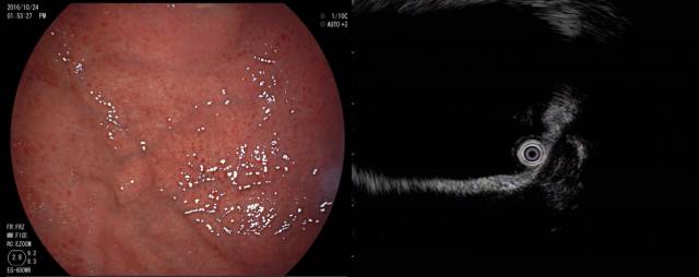 当EUS遇到“假瘤子”(二)——都是“隔壁老王”惹的祸(毗邻外压)