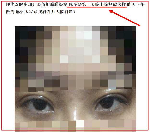 纳米无痕双眼皮埋线怎么恢复得快,埋线双眼皮拆线能恢复到原来吗