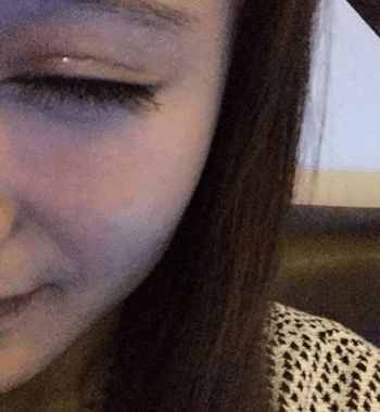 埋线双眼皮的正确操作手法,埋线双眼皮很浅