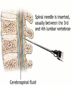 腰椎穿刺术操作流程完成时间,腰椎穿刺术操作考核评分标准