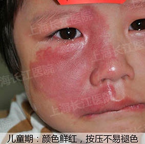 为什么红胎记会突出皮肤表面,光动力治红胎记失败