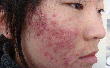 痘痘都是去哪里治好的,三角区长痘痘治疗的全部过程