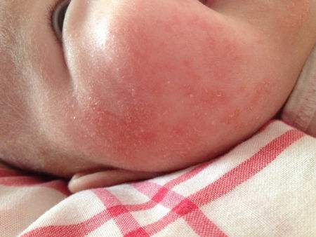 脸上有红色血丝怎么去除,新生儿脸上有红色血丝