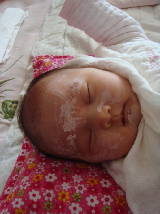 宝宝湿疹了怎么办,宝宝湿疹渗液怎么办