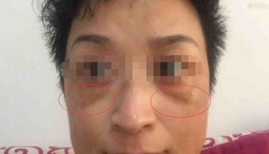 褐斑起因及调养,脸上出现褐斑是肝有问题吗