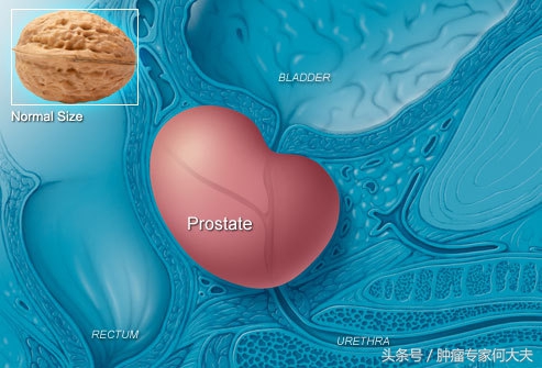 前列腺癌晚期贫血腿肿怎么办,前列腺癌晚期一侧腿肿怎么办