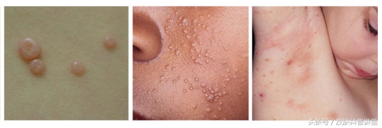 小孩传染性软疣冷冻后变成了水泡,儿童常见皮肤病疣
