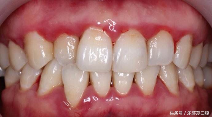 突然牙疼警惕四种病,牙疼不算病的句子