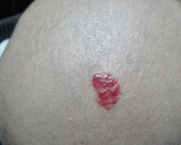 小型草莓状血管瘤能不能用针扎破,血管瘤被蚊子咬了注意事项