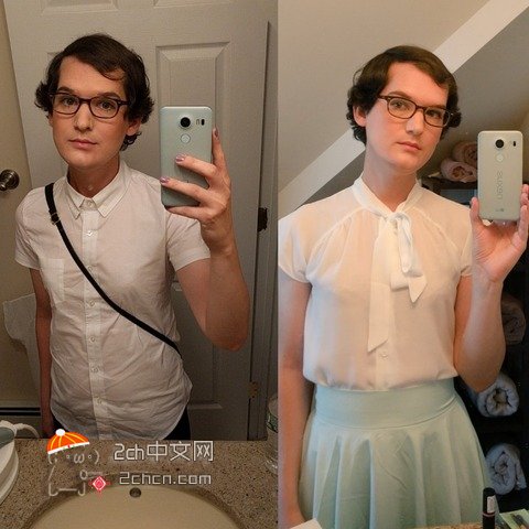 秃头大叔服用雌性激素,秃头男吃雌激素一年