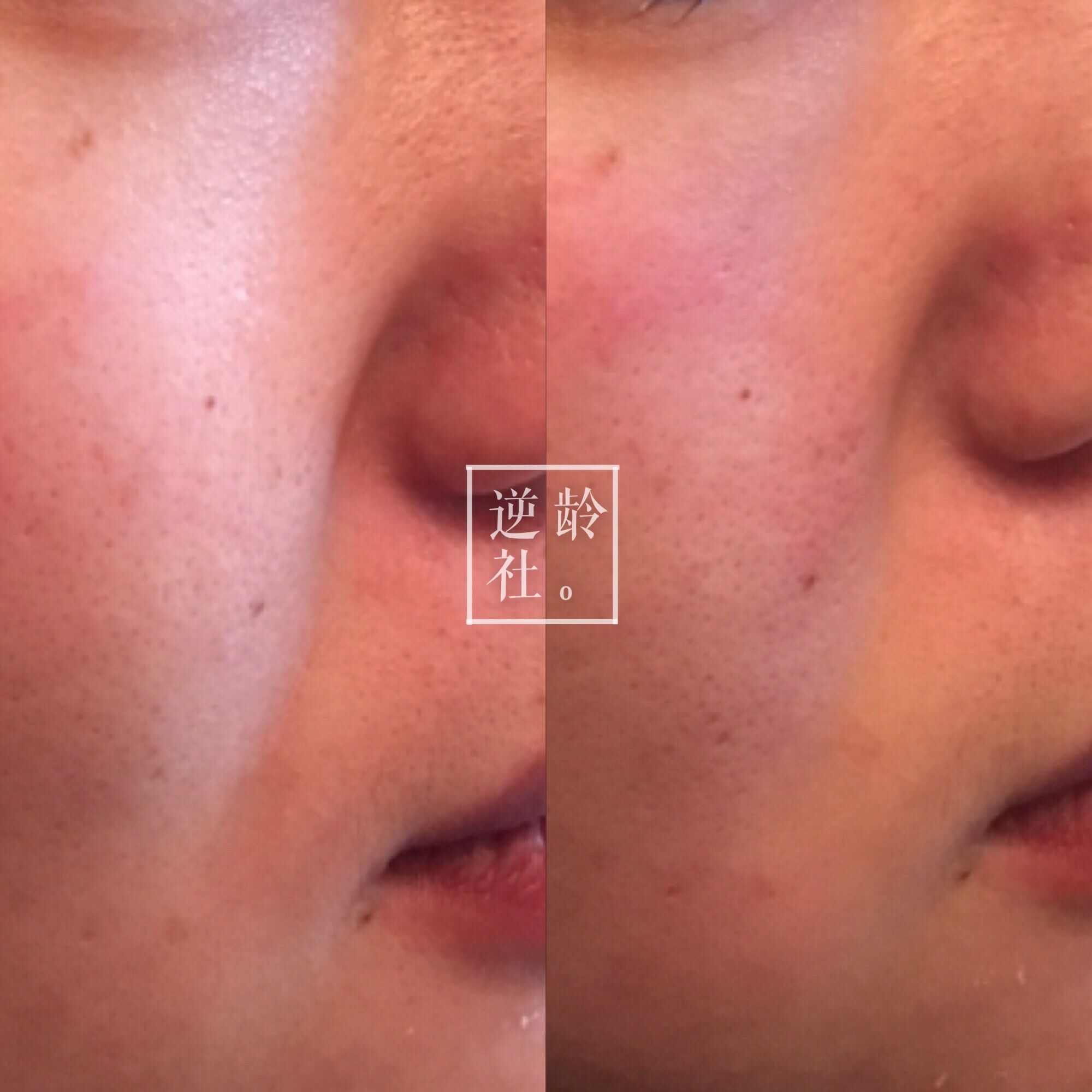 逆龄精雕好还是超声刀好,35岁做超声刀效果好吗