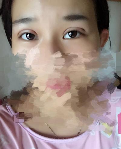 韩式三点双眼皮恢复单眼皮,韩式三点式双眼皮是永久性的吗