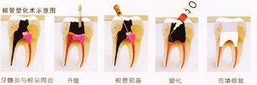 根管治疗的适应症有哪些？需要多少钱？