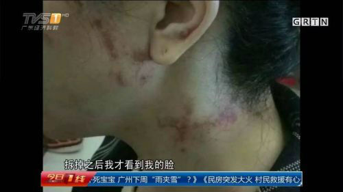 恐怖！深圳女子烫发直喊痛竟是药水腐蚀了皮肤