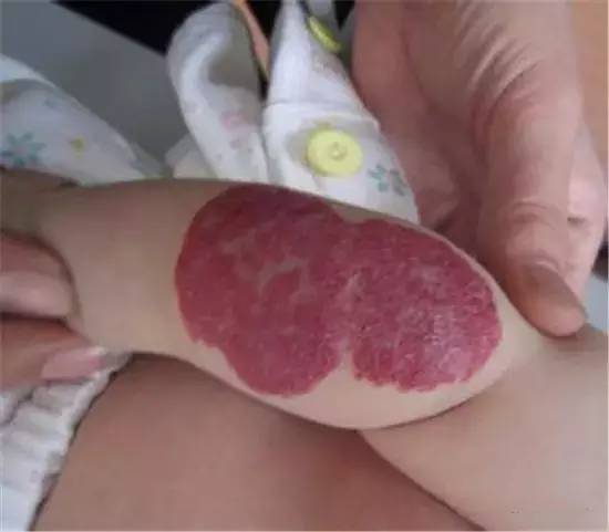 哪些胎记有危险,宝宝胎记是什么原因造成的