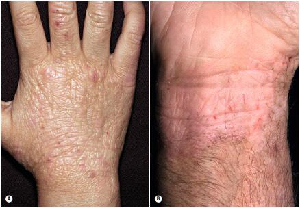 孩子湿疹最佳图片,孩子面部湿疹