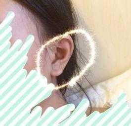 耳软骨垫鼻尖会被全部吸收吗,耳软骨垫鼻尖是不是很容易吸收