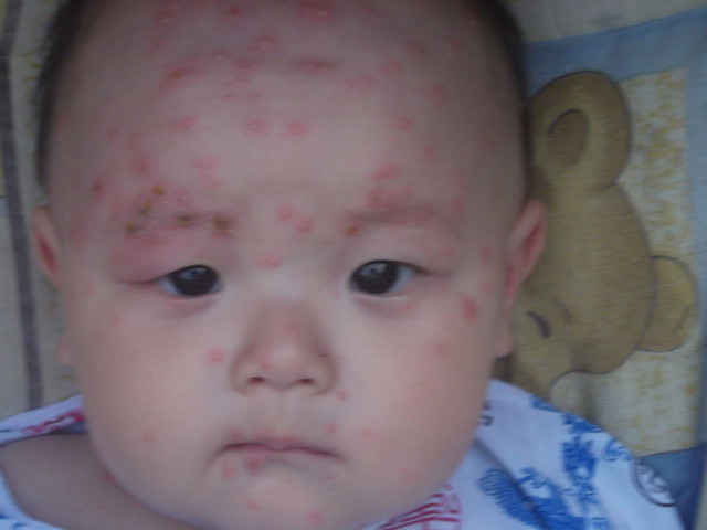 六个月宝宝出水痘发烧了怎么办,六个月宝宝感染水痘