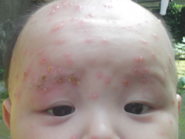 六个月宝宝出水痘发烧了怎么办,六个月宝宝感染水痘