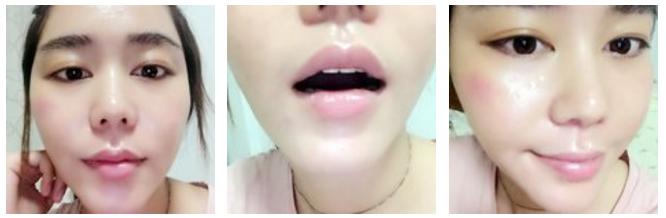 玻尿酸丰唇即刻效果,玻尿酸丰唇有几种唇型