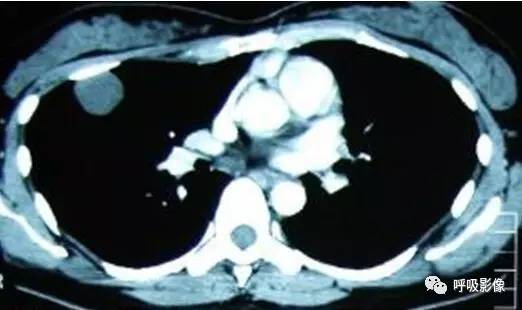 绒毛膜癌转移到脑,绒毛膜癌肺转移