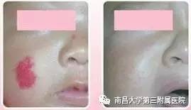 哪些胎记有危险,宝宝胎记是什么原因造成的