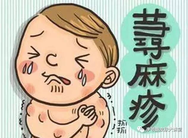 麻疹荨麻疹反复是什么原因,麻疹持续瘙痒几天