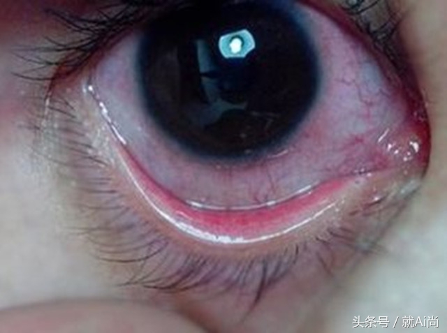 参天玫瑰眼药水和fx区别在哪里 (fx玫瑰眼药水)