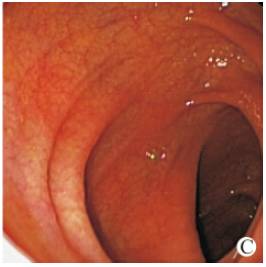 急性肠炎吃什么药效果快止泻,急性肠炎拉肚子如何快速止泻